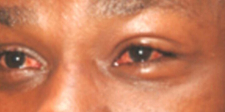 500 treated after eye disease hits Ayod county